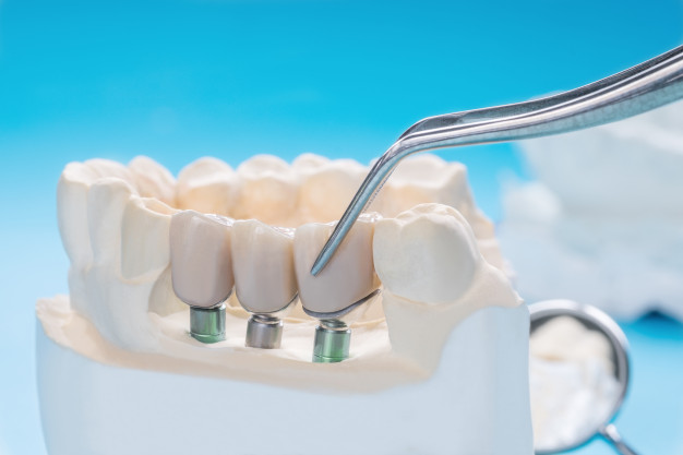 Implant Dental Implants