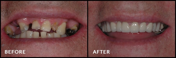 partial-dentures-1-min