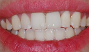 Implant-Retained crowns