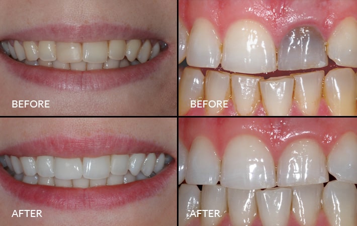 Teeth Whiting-3-min