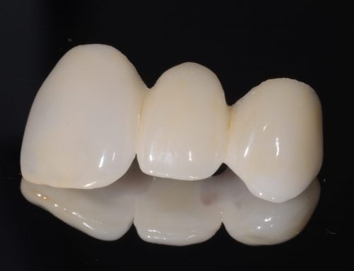 Ceramic Veneers Melbourne – Cost Effective