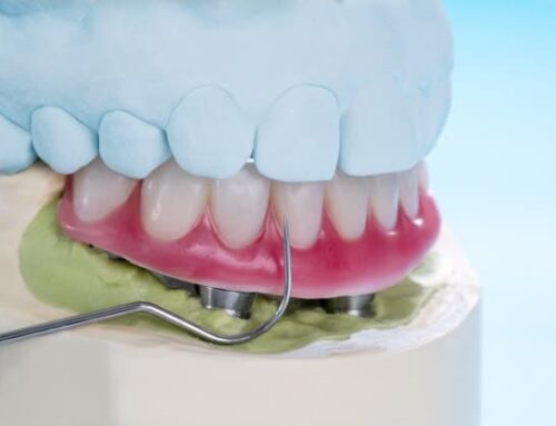 All on 4 – permanent teeth solution